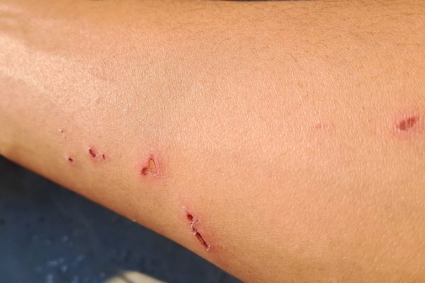 Đắp lá, uống thuốc nam trị dại: Thực hư và nguy cơ