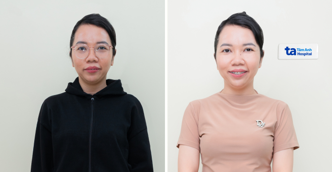 Chị Mai trước và sau xóa cận. Ảnh: Bệnh viện Đa khoa Tâm Anh
