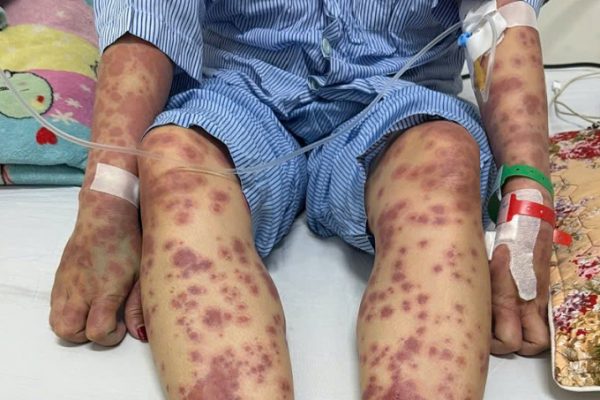 Cảnh báo: Dị ứng nặng do uống viên giảm cân thải độc