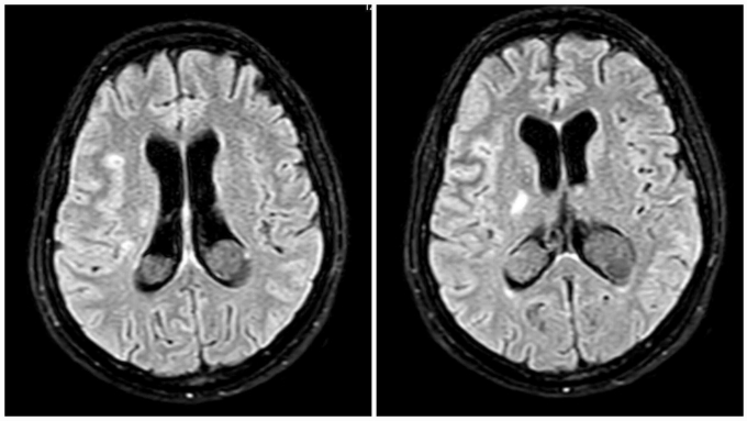 Kết quả MRI sọ sảnphụcho thấy tổn thương chất trắng rải rác hai bên bán cầu não. Ảnh: Bác sĩ cung cấp