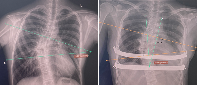 Ảnh X-quang trước mổ (trái) cho thấy vẹo cột sống ngực, góc Cobb 22,5 độ và ảnh X-quang sau mổ (phải) ghi nhận thanh nâng đúng vị trí, vẹo cột sống có cải thiện góc Cobb 18 độ. Ảnh: Bệnh viện  cung cấp