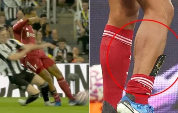 Van Dijk bị vào bóng: Dấu giày hằn sâu trên chân