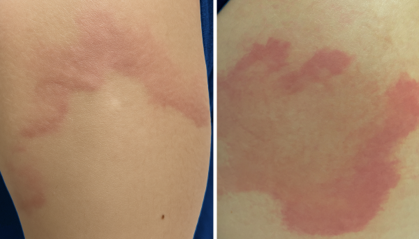 Dị ứng mề đay mạn tính: Nguyên nhân và cách điều trị