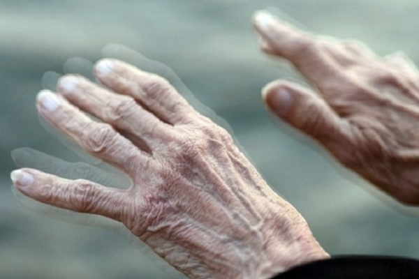 Khó khăn vận động ở bệnh nhân Parkinson: Các vấn đề thường gặp