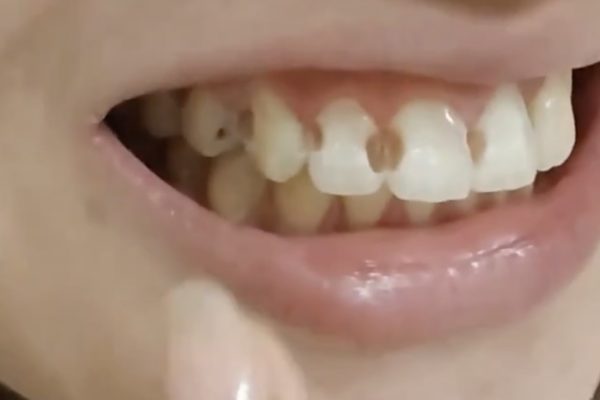 Niềng răng 5 năm: Cô gái phát hiện 8 răng bị lỗ