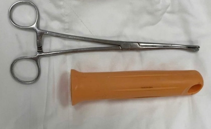 Dị vật được mổ lấy ra khỏi cơ thể bệnh nhân. Ảnh: Bệnh viện cung cấp