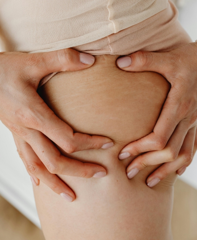 Nhiều mẹ bầu đối diện vết rạn ở vùng đùi. Ảnh: Pexels