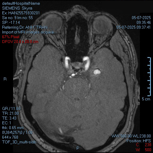 Hình ảnh MRI khối u mạch máu 9x14 mm nhưng lại ẩn tại vị trí nhạy cảm, sâu tới 5 cm trong lớp vỏ não. Ảnh: FV