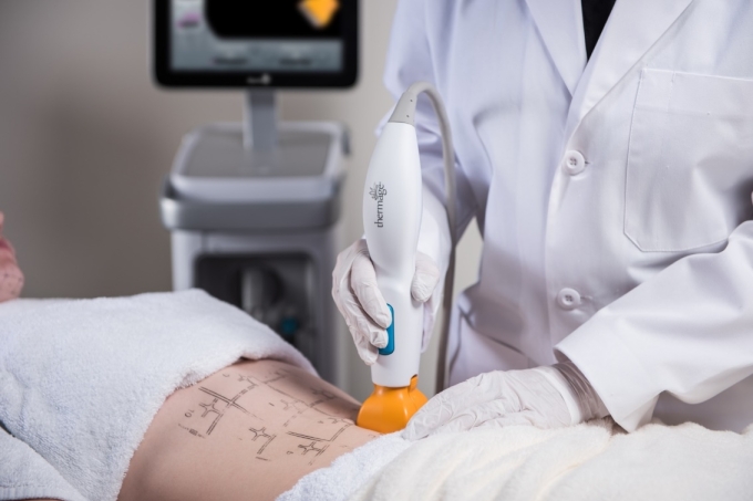 Trường hợp làm đẹp với máy Thermage FLX. Ảnh: Inamed