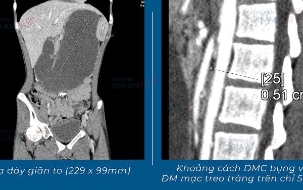 Hội chứng lạ khiến chàng trai ‘ăn đủ mà vẫn đói’ chỉ nặng 38kg