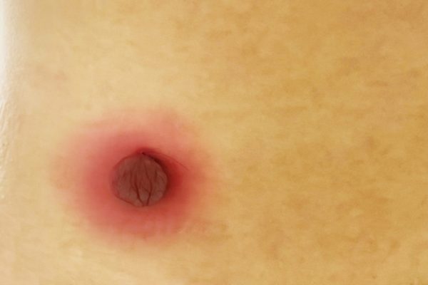 Cảnh báo: Nhiễm trùng do mẹo chữa u bằng tóc