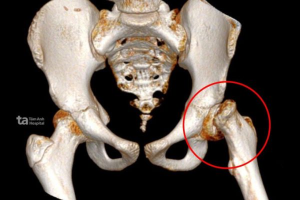 Trượt chỏm xương đùi ở trẻ: Cảnh báo và điều trị sớm