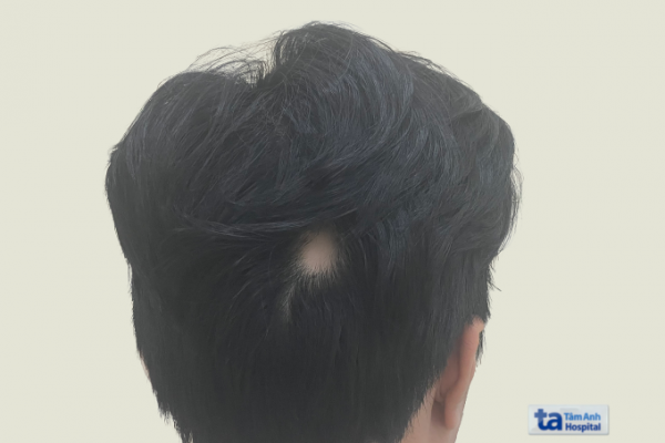 Hói Đầu Tuổi 17: Nguyên Nhân và Giải Pháp
