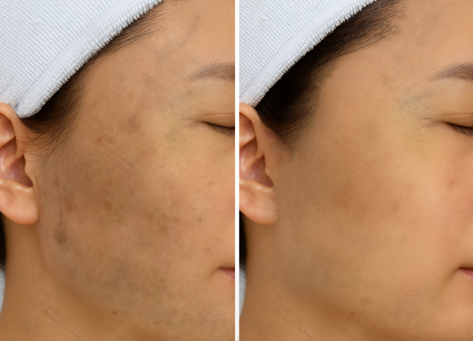 Các đốm nâu và sạm nám trên mặt chị Mỹ mờ dần sau gần một năm điều trị. Ảnh: Bệnh viện Đa khoa Tâm Anh
