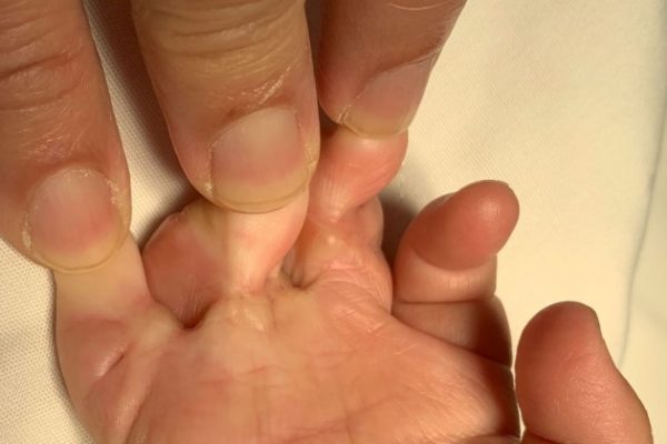 Sơ cứu bỏng nước nóng, bỏng pô xe: Giảm sẹo hiệu quả
