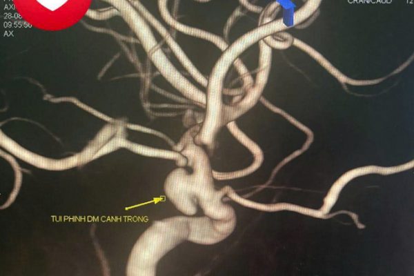 Cứu sống phụ nữ 33 tuổi khỏi ‘bom nổ chậm’ não