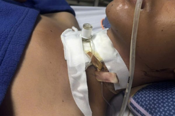 Dây điện sa xuống đường vướng cổ thiếu niên làm đứt khí quản