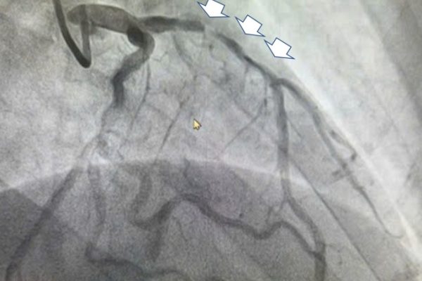 30 năm hút thuốc: Nhồi máu cơ tim và cảnh báo