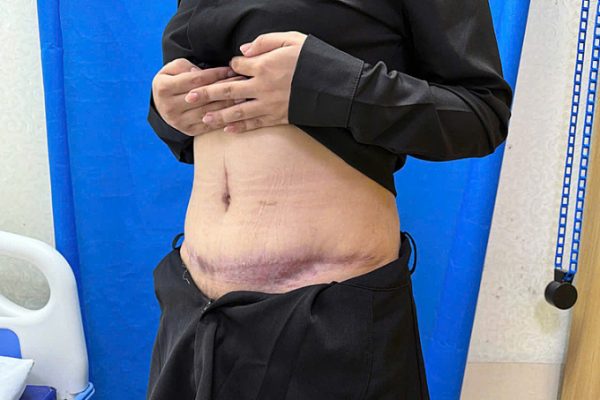 Biến dạng bụng sau tiêm sẹo hút mỡ: Cảnh báo rủi ro