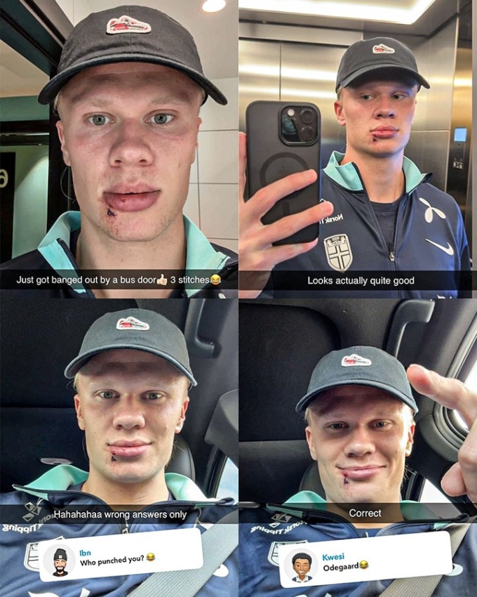 Haaland đăng ảnh bị rách môi và đổ vui cho Odegaard.
