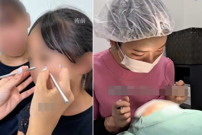 Thẩm mỹ viện ở Nhật Bản gây tranh cãi khi công khai quá trình cắt mắt hai mí cho bé 10 tuổi. Ảnh chụp màn hình: Weekly Womens Prime