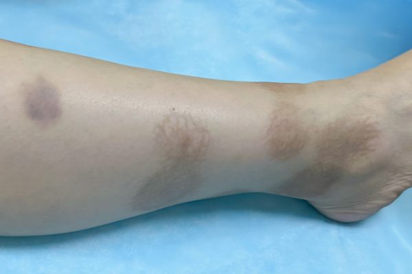 Nhiễm nấm da: Dấu hiệu và cách phân biệt với dị ứng