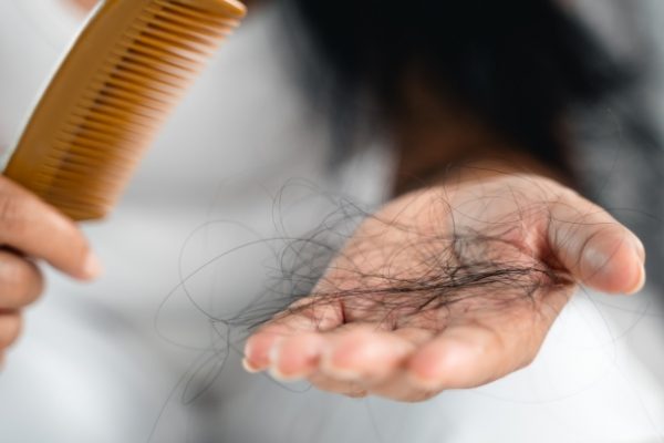 Rụng tóc sau sốt xuất huyết: Nguyên nhân và cách khắc phục