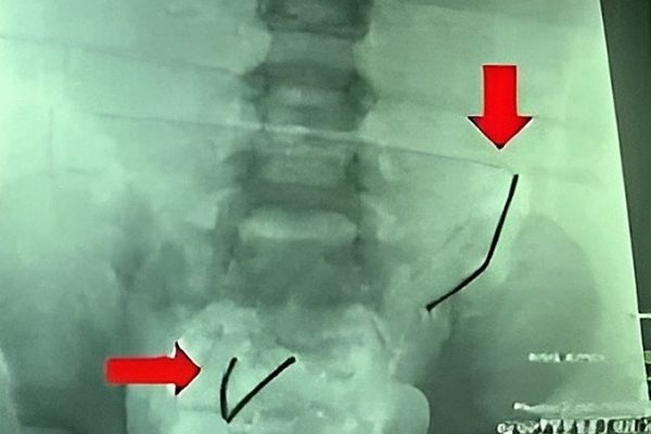 Cảnh báo: Bé trai thủng ruột vì nuốt 20 nam châm xếp hình