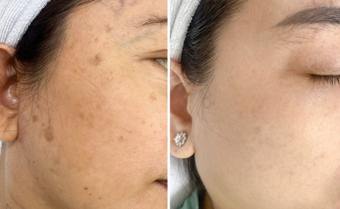 Các đốm tàn nhang của chị Linh đã mờ đáng kể sau hơn 1 năm điều trị (phải). Ảnh: Bệnh viện Đa khoa Tâm Anh