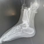 Nối thành công bàn chân đứt lìa cho nữ sinh 19 tuổi