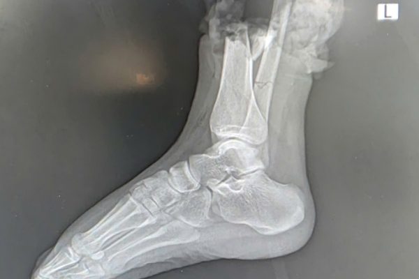 Nối thành công bàn chân đứt lìa cho nữ sinh 19 tuổi