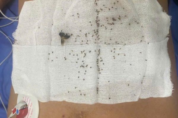 Thoát chết: Bị 300+ ong đốt