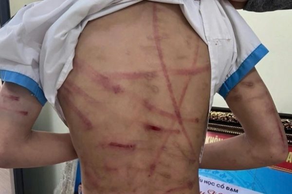 Bạo hành trẻ em: Những bi kịch đau lòng