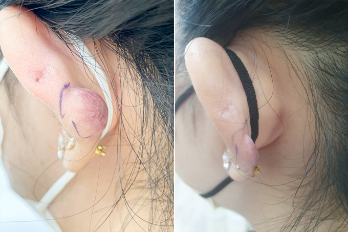 Phần sẹo lồi của chị Thi thu gọn hơn sau 4 lần tiêm hoạt chất triamcinolone. Ảnh: Bệnh viện Đa khoa Tâm Anh