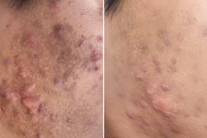 Các vết sẹo của Lâm phẳng và mềm hơn sau 3 lần điều trị. Ảnh: Bệnh viện Đa khoa Tâm Anh
