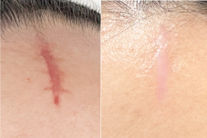 Vết sẹo của chị Phương mờ đi, phẳng hơn sau điều trị. Ảnh: Bệnh viện Đa khoa Tâm Anh
