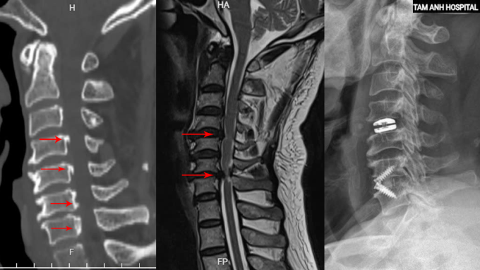 Tổn thương vôi hóa dây chằng dọc sau (trái), thoát vị đĩa đệm (giữa) của bệnh nhân được khắc phục sau phẫu thuật (phải). Ảnh: Bệnh viện Đa khoa Tâm Anh