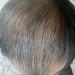 Dấu hiệu nhận biết thiếu protein ở nam giới sau tuổi 35