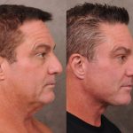 Căng da mặt: Nam giới Thung lũng Silicon chi tiền tỷ níu giữ tuổi xuân