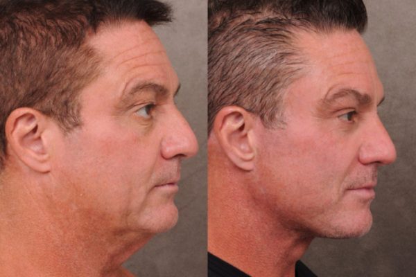 Căng da mặt: Nam giới Thung lũng Silicon chi tiền tỷ níu giữ tuổi xuân