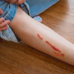 Chó cắn bị nhức, mưng mủ: Dấu hiệu nhiễm trùng và cách xử lý