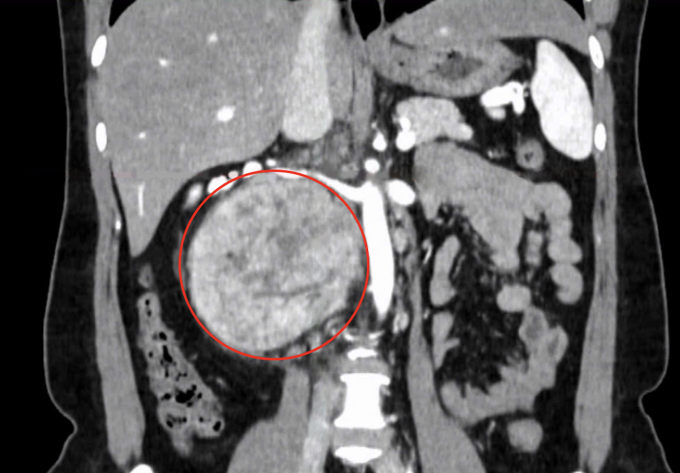 Khối u lớn sau phúc mạc của chị Ngà. Ảnh: Bệnh viện Đa khoa Tâm Anh