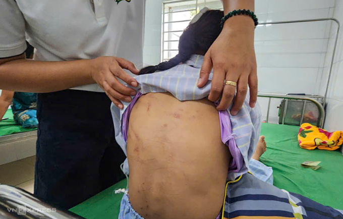 Sau hai ngày điều trị, các vết bầm sau lưng Vy dần mất, song đầu còn sưng vì có ba vết thương hở, phải khâu 7 mũi. Ảnh: Đức Hùng