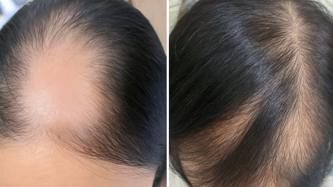 Phần đỉnh đầu và trán chị Mỹ đã mọc trở lại sau 6 lần tiêm triamcinolone. Ảnh: Bệnh viện Đa khoa Tâm Anh