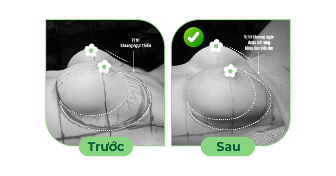 Sau khi đánh giá hiện trạng, bác sĩ Vũ dùng dao siêu âm tạo hình lại khoang đặt túi phù hợp với túi ngực mới. Ảnh: Dr. Cao Vũ