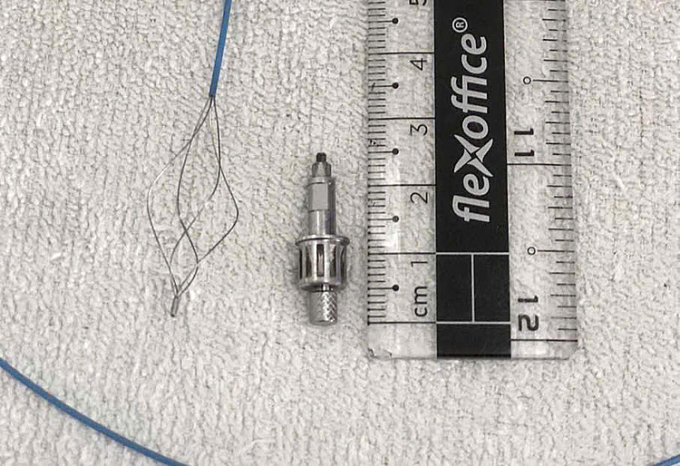 Dị vật là dụng cụ nha khoa kim loại sau khi được lấy ra. Ảnh: Bệnh viện cung cấp