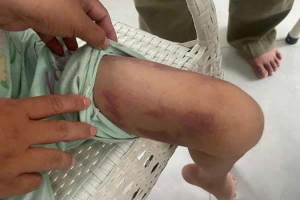 Bạo hành trẻ em: Mẹ và người tình bị bắt vì đánh con gái 9 tuổi