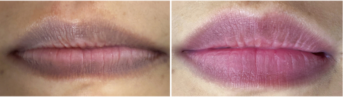 Môi chị Hường đều màu và tươi tắn hơn sau 3 lần bắn laser. Ảnh: Bệnh viện Đa khoa Tâm Anh