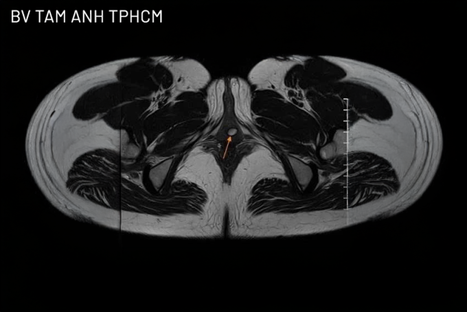 Bác sĩ Liên (giữa) cùng êkíp phẫu thuật cắt túi thừa niệu đạo cho chị Mai. Ảnh: Bệnh viện Đa khoa Tâm Anh
